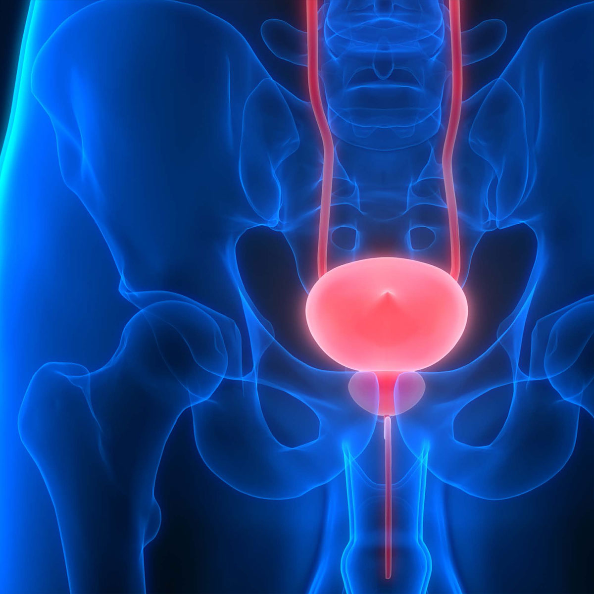 Neurogenic bladder