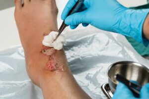 preventing wound infection