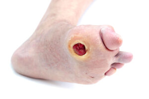 diabetic foot wound