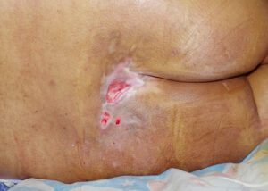 managing pressure ulcers